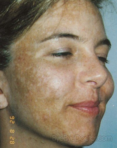 Melasma Treatment, Pictures, Causes, Symptoms, Cure