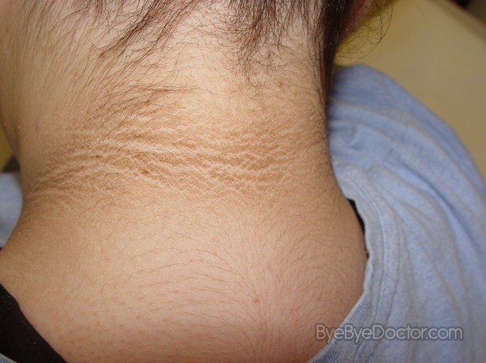 Acanthosis Nigricans – Pictures, Treatment, Cure, Symptoms ...