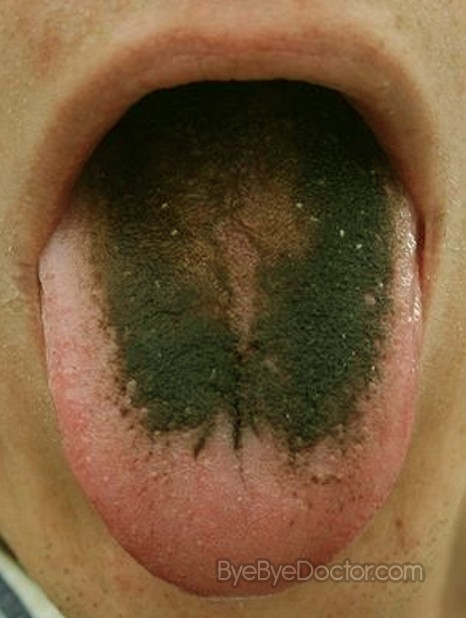 Hairy Tongue Cure 41