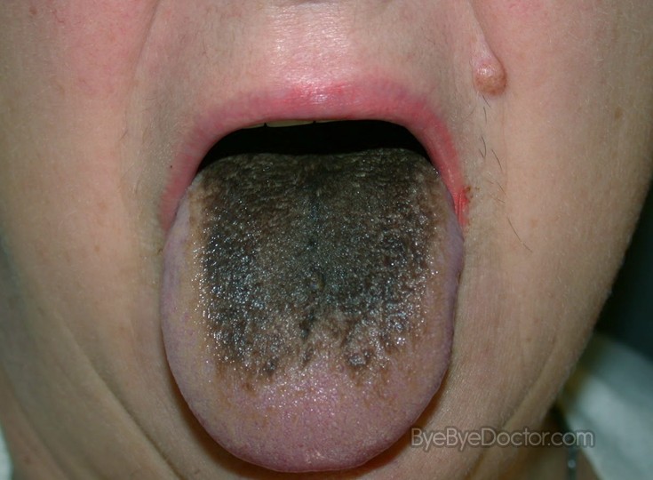 Cure For Hairy Tongue 26