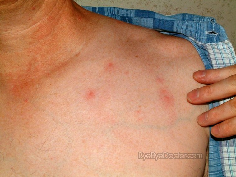 How long can a rash caused by chiggers last?