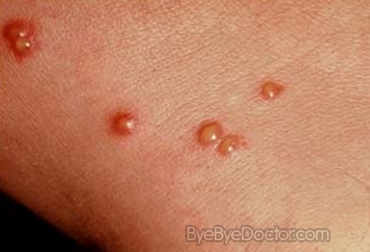 Chigger Bite â€“ Pictures, Symptoms and Treatment