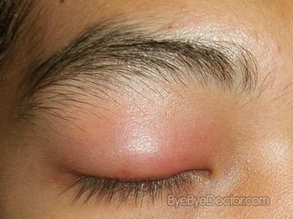 What causes red eyelids?