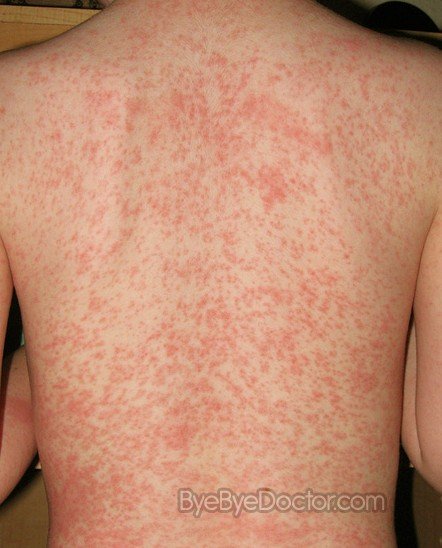 Different Types of Rashes - Parents