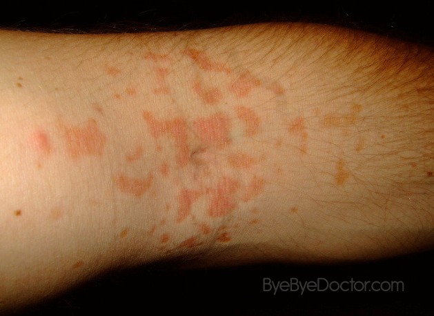 skin rashes on forearms