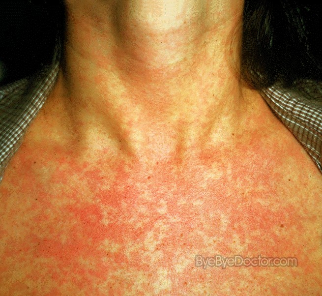 What causes a red circle rash on the chest?