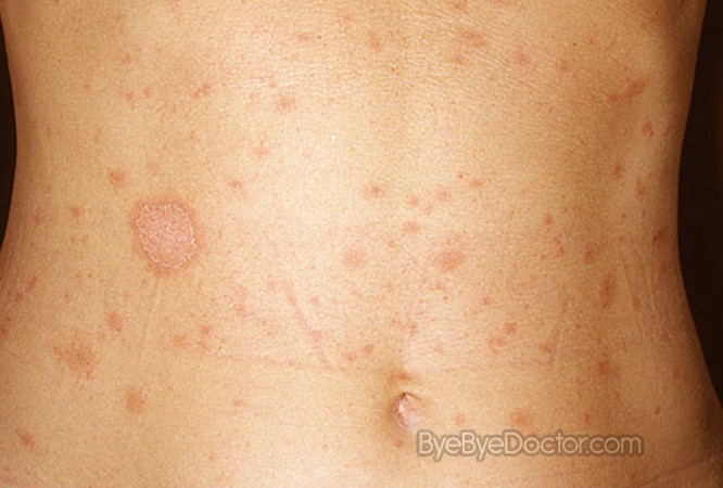 What are some different types of rashes?