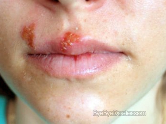 pictures of oral herpes