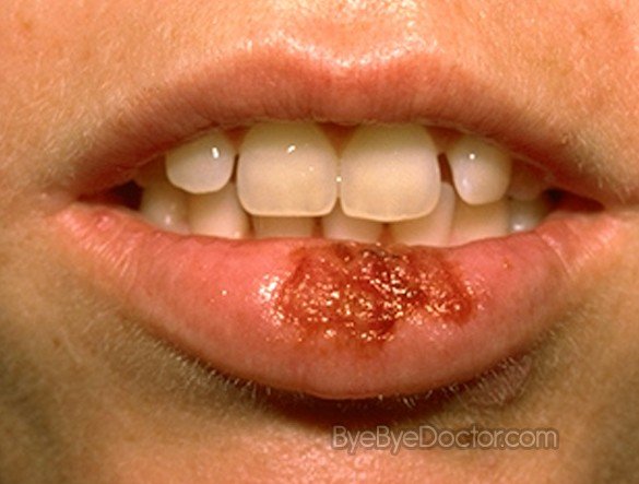 Herpetic stomatitis | University of Maryland Medical Center