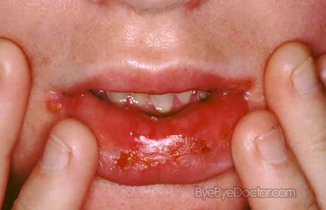 PKIDs | Oral Herpes Signs Symptoms Treatment