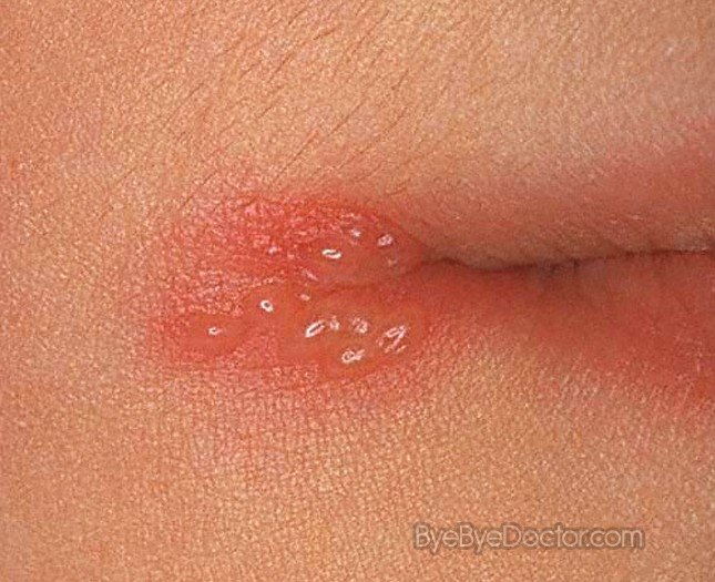 Pictures of herpe mouth sores | Lifescript.com