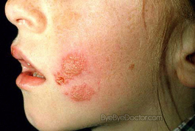 signs of herpes. Oral Herpes Pictures