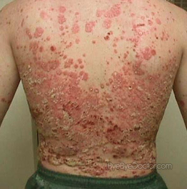 Psoriasis Daily Blog, Experts & Community ...