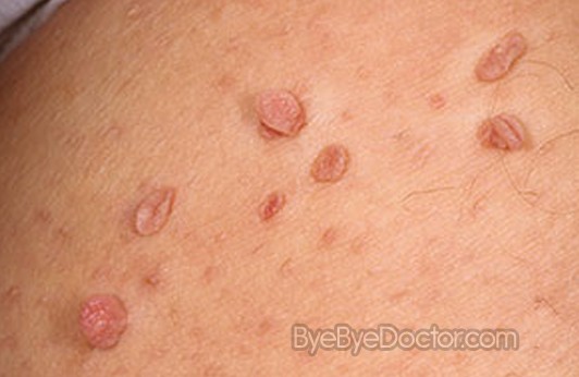 4 Ways to Get Rid of Skin Tags - wikiHow