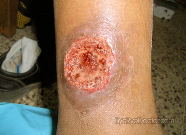 skin ulcer images #10