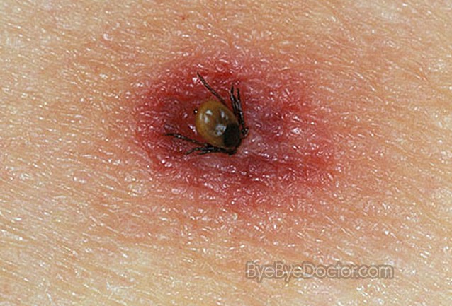What does a deer tick bite look like?