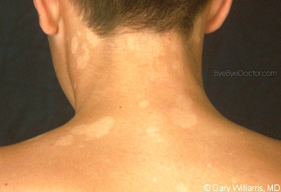 tinea versicolor on neck