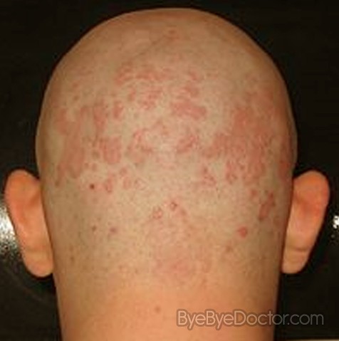 Malassezia Fungi Are Specialized to Live on Skin and ...