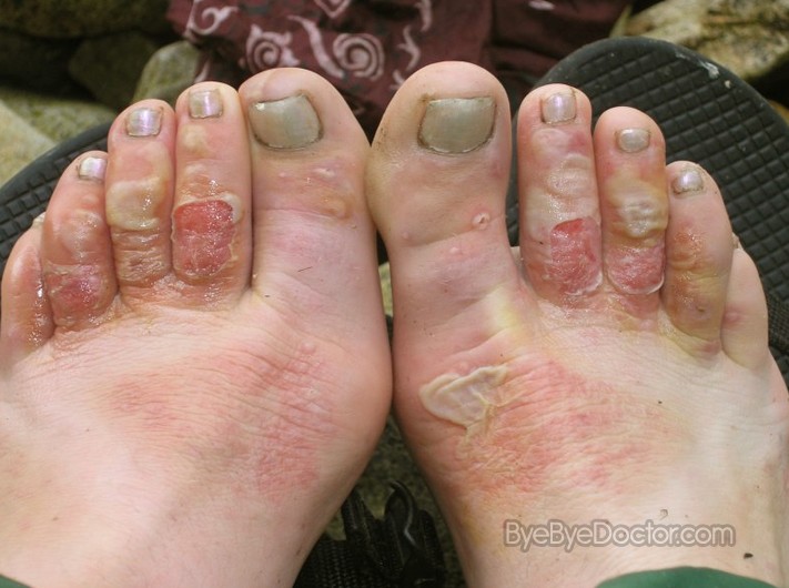 foot rot human