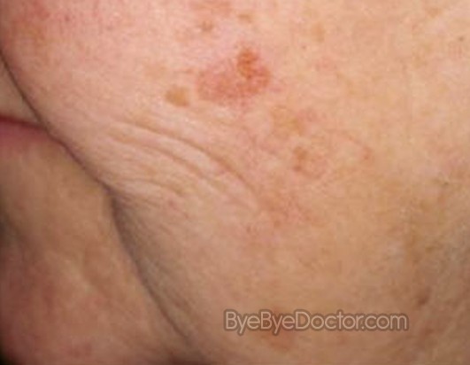 Acanthosis Nigricans in Adults: Condition, Treatments, and ...