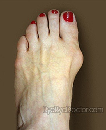 Bunion Pain