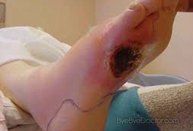 diabetic foot