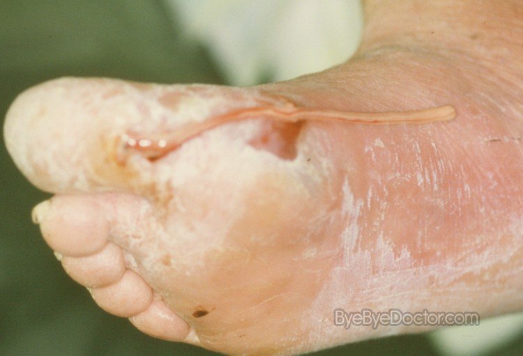 Diabetic Foot Problems