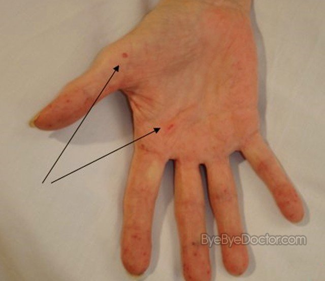 Hereditary Hemorrhagic Telangiectasia