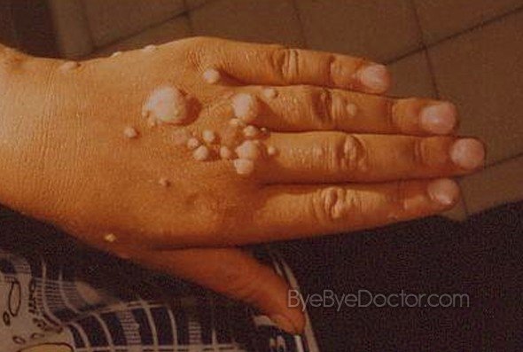 warts on tongue. HPV Warts Pictures