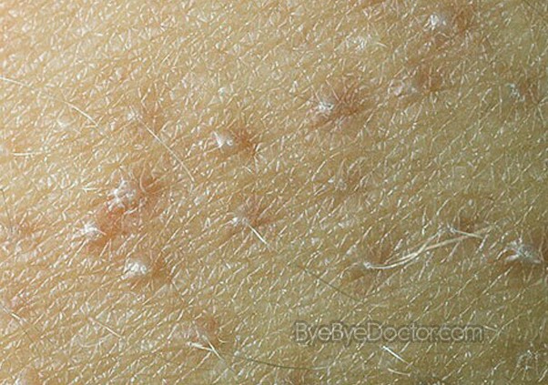 Pimples on Arms
