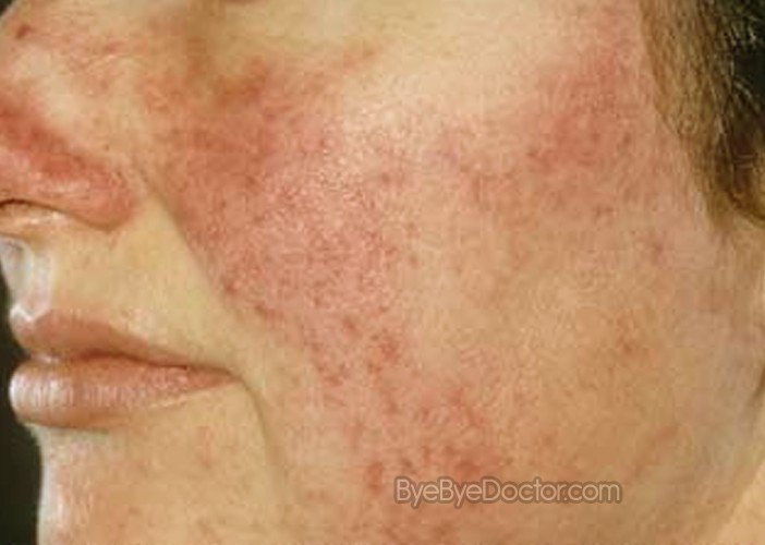 Rosacea Pictures