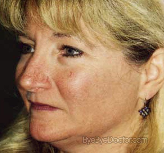 Rosacea Pictures