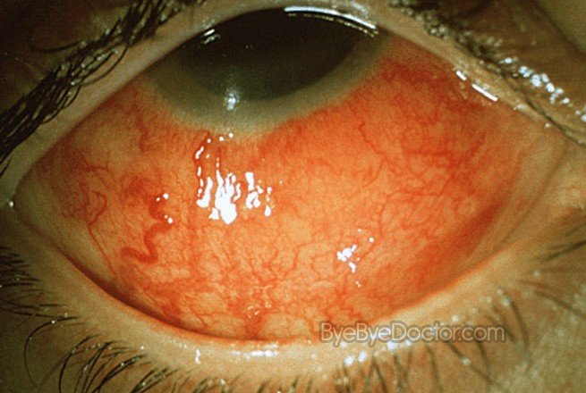 Scleritis