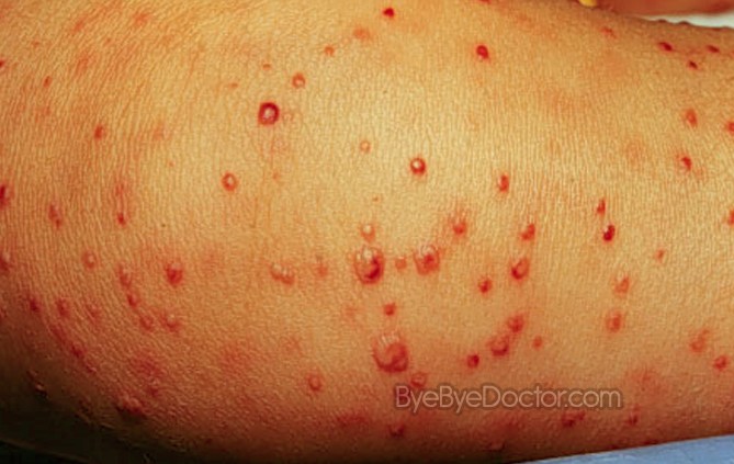 Treatments for Staphylococcal infection - RightDiagnosis.com
