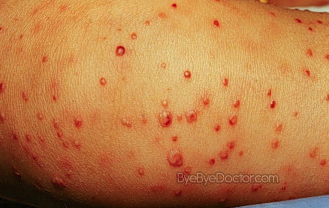 Staph Infection Pictures Symptoms Causes Treatment 3775