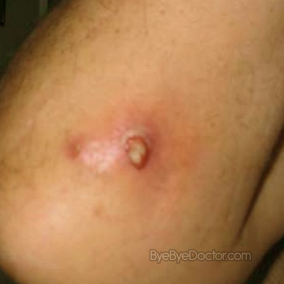 Staphylococcal infection - Wikipedia