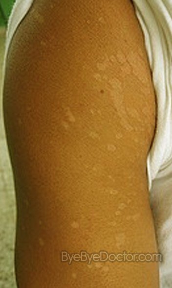 What are the causes of white patches of skin?