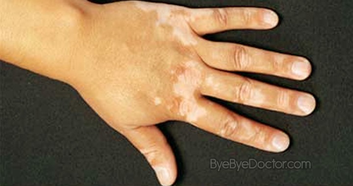 white spots on skin - hands
