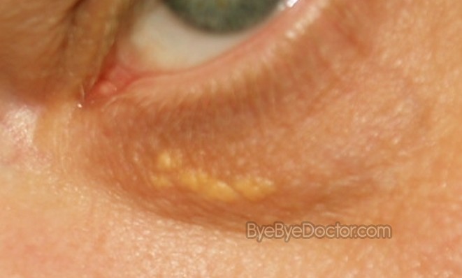 white spots on skin near eye