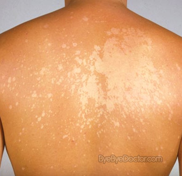 White Skin Spots On Skin