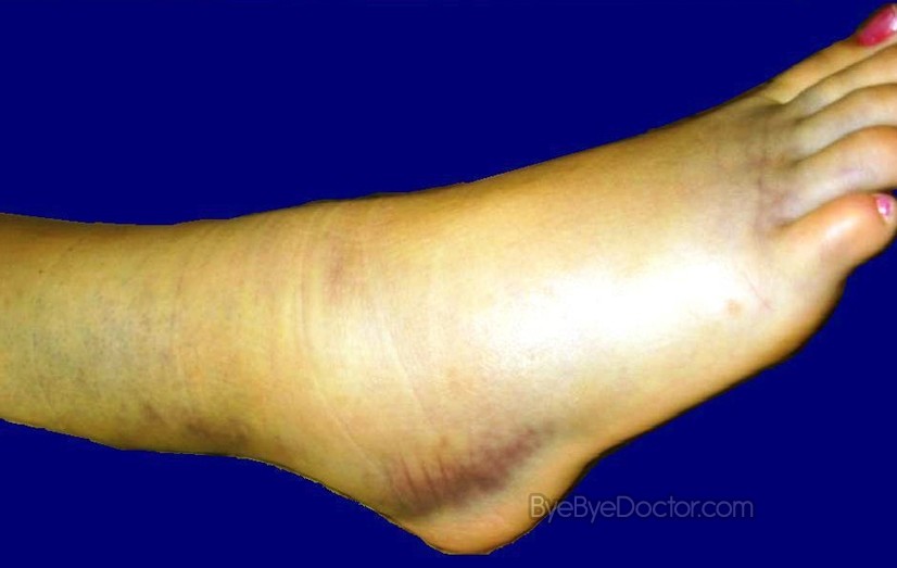 inversion ankle sprain. for ankleankle sprain mild