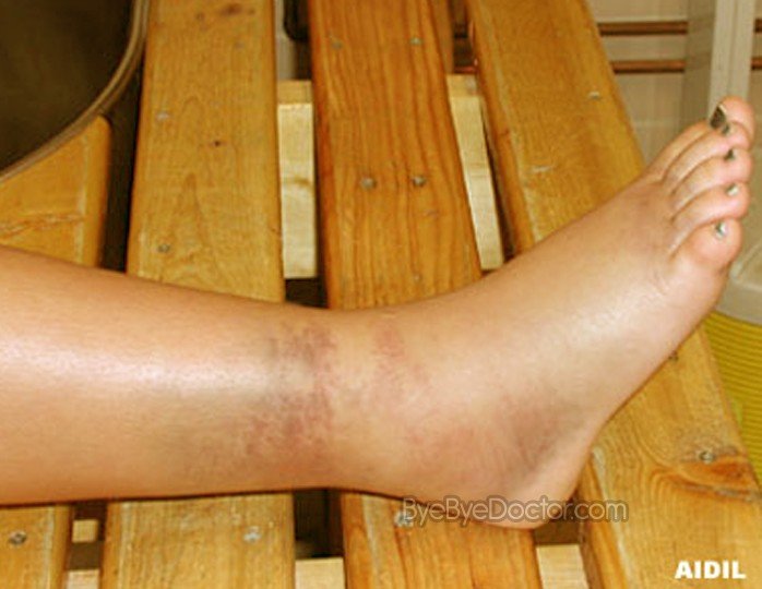 Ankle Sprain