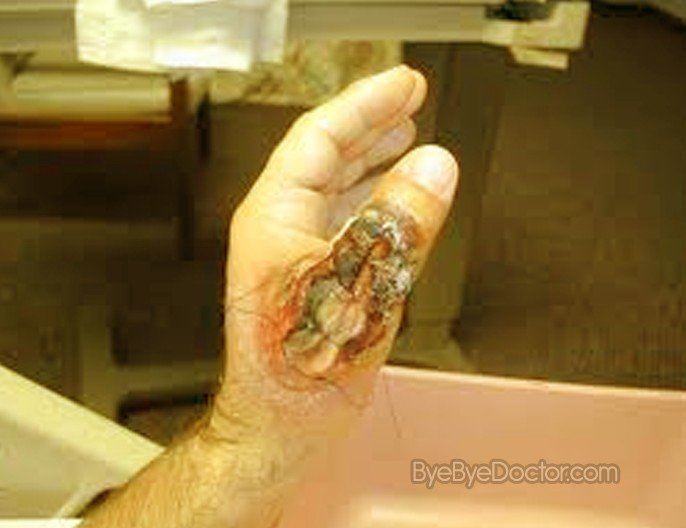 http://byebyedoctor.com/wp-content/uploads/2011/02/brown-recluse-spider-bite-4.jpg