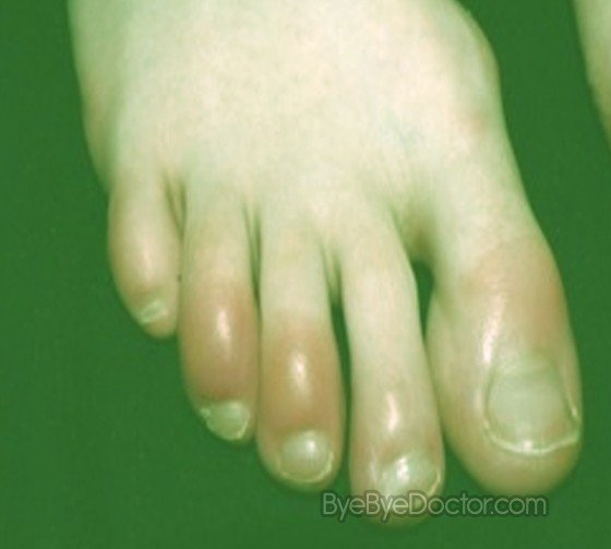 Chilblains Pictures, Images & Photos | Photobucket