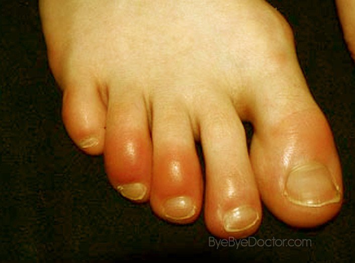 Chilblains