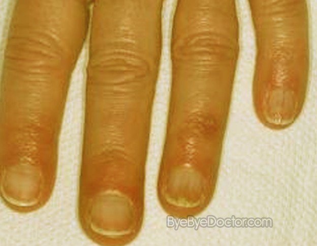 Chilblains – Pictures, Symptoms, Causes, Treatment