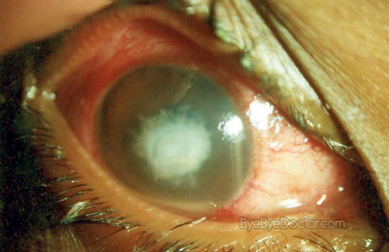 Corneal Ulcer Treatment, Pictures, Symptoms, Causes