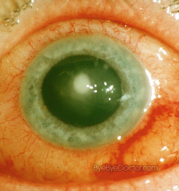 Corneal Ulcer