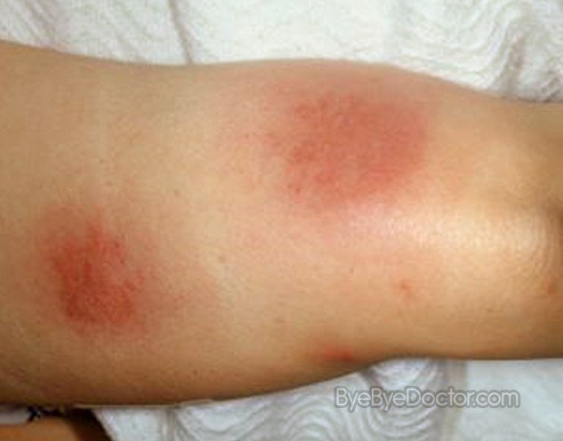 Erythema Nodosum: Symptoms, Causes, Diagnosis, and ... - WebMD