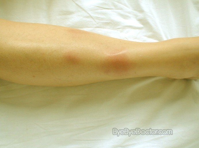 Erythema Nodosum